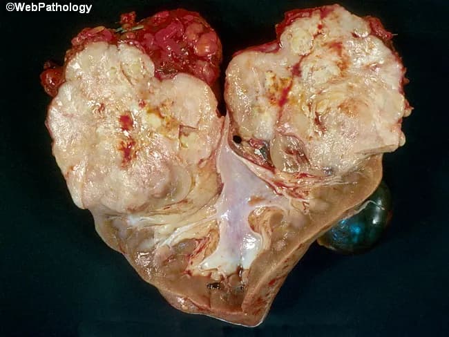 Gross pathology photograph of a nephrectomy kidney displaying an exophytic yellow-tan tumor with focal hemorrhage and necrosis. The cut surface reveals a large mass intermingled with hemorrhagic and necrotic zones within the renal parenchyma. The exterior of the kidney shows irregular borders. Microscopically, the lesion comprises predominantly malignant fibrous histology–like sarcomatous areas characterized by highly pleomorphic spindle- to epithelioid-shaped cells, marked mitotic activity, and a storiform-to-haphazard architecture. Intermixed are small foci of conventional clear cell renal cell carcinoma, confirming histologic heterogeneity and suggesting a biphasic neoplasm or collision/dedifferentiation. Areas of extensive necrosis and hemorrhage contribute to the gross appearance and may correlate with aggressive behavior. The tumor appears intraparenchymal, infiltrating renal cortex and medulla, with potential involvement of surrounding parenchyma. Clinically, such renal tumors portend poorer prognosis due to sarcomatoid transformation and RCC admixture. Immunohistochemical and molecular studies are often required to confirm lineage and distinguish from primary renal sarcomas. This image provides a reference for educational pathology, aiding recognition of mixed histology renal tumors, differentiation from pure sarcomas, and correlation with histology slides, differential diagnoses, and treatment decision-making in nephrectomy specimens, with implications for prognosis, therapy planning, and follow-up."