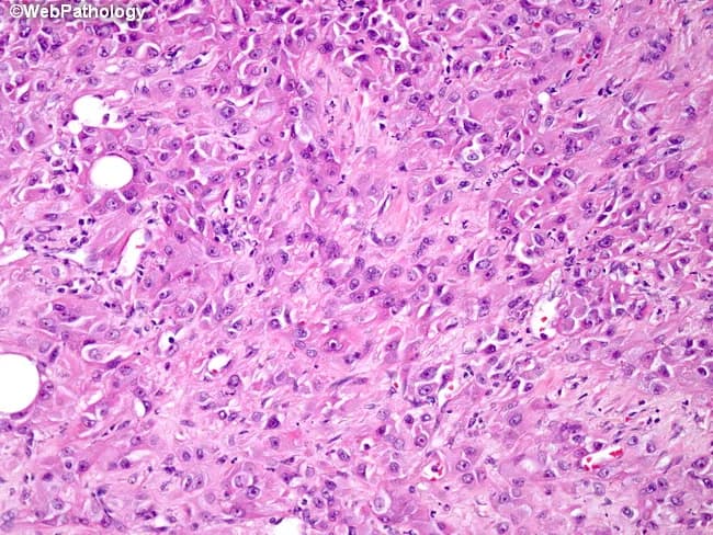 This histopathology slide depicts liver parenchyma prepared for light microscopy and stained with hematoxylin and eosin (H&E). The tissue shows polygonal hepatocytes arranged in an orderly plate-like architecture with cords separated by sinusoids. The cytoplasm is eosinophilic and mildly granular; nuclei are round or oval with inconspicuous nucleoli. Several large, clear vacuolar spaces within hepatocytes are compatible with macrovesicular fatty change (steatosis). The overall architecture appears preserved, but occasional cytoplasmic ballooning and mild cytoplasmic rarefaction may reflect early hepatocellular stress. Ductal structures and portal tracts are not the dominant features in this field and appear limited to scattered portal elements. There is no conspicuous necrosis, active inflammation, or significant fibrosis visible at this magnification, though sampling bias may obscure subtle changes. The image emphasizes hepatocellular morphology, lipid accumulation, and cellular detail that are essential for assessing fatty liver disease, steatohepatitis, or metabolic hepatopathy. Clinically, these findings can correlate with nonalcoholic fatty liver disease (NAFLD), alcoholic hepatopathy, or other causes of hepatic steatosis. Differential considerations include steatosis without inflammation, steatohepatitis, drug-induced liver injury with fatty change, or minimal chronic hepatitis. The slide is suitable for teaching hepatic histology, fatty change assessment, and correlating histologic pattern with clinical liver function abnormalities.