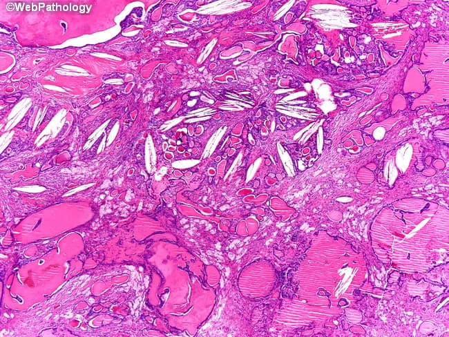 This is a histopathology image from renal tissue demonstrating a thyroid-like follicular variant of renal cell carcinoma. Acquired as a surgical specimen from the kidney, the slide was prepared with standard hematoxylin and eosin staining and examined under bright-field light microscopy at low- to high-power magnification. The tumor exhibits thyroid follicle-like architecture characterized by scattered microfollicles and larger macrofollicles filled with colloid-like eosinophilic material, mimicking benign and malignant thyroid lesions. The follicles are embedded in a fibromyxoid stroma containing chronic inflammatory cells and occasional cholesterol clefts, features that contribute to a distinctive pattern and may complicate cytologic interpretation. Cytologic atypia is minimal, consistent with a low-grade neoplasm; the tumor cells are arranged in a cohesive epithelial lining around colloid-filled lumina, with well-preserved nuclear polarity and subtle mitotic activity if present. Clinically, this entity is rare, often discovered incidental during imaging or nephrectomy for unrelated reasons, and generally portends a favorable prognosis compared with higher-grade RCCs. Differential diagnosis includes metastatic thyroid carcinoma and other follicular-pattern RCCs; immunohistochemistry (e.g., PAX8 positive, TTF-1 negative) and molecular profiling aid accurate classification. Recognize this pattern in diagnostic pathology to prevent misinterpretation and guide appropriate clinical management. This image supports teaching cases of TLCK in pathology education.