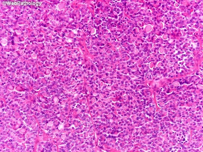 This histopathology image shows a renal neoplasm with thyroid-like follicular differentiation. The section is formalin-fixed and stained with Hematoxylin and Eosin. At low-to-intermediate magnification, the tumor forms numerous small follicles and microfollicles arranged in a predominantly hypercellular pattern; some larger follicles contain colloid-like material resembling thyroid colloid. The epithelial cells are cuboidal to low-columnar with round to oval nuclei, inconspicuous nucleoli, and scant to moderate cytoplasm. Nuclear features show mild to moderate pleomorphism; mitotic activity is infrequent in this field. The architecture mimics thyroid tissue, with follicles ranging from microfollicular to near-solid arrangements and occasional colloid-like intraluminal material giving a heterogeneous appearance. There is no obvious invasion into adjacent stroma within the image; deeper sections may reveal capsular or vascular invasion in other examples. The differential diagnostic considerations include thyroid-like follicular carcinoma of the kidney, other renal cell carcinoma subtypes such as papillary or chromophobe variants, and metastatic thyroid carcinoma. Immunohistochemical profiling (not shown) typically shows PAX8 positivity with TTF-1 and thyroglobulin negativity, supporting a renal origin despite thyroid-like morphology. Clinically, recognition of this pattern is important to distinguish from metastatic thyroid disease and other RCC subtypes for accurate diagnosis and management. Accurate classification guides prognosis, treatment, and surveillance strategies for clinicians.