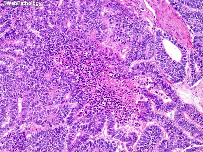Histopathology, bright-field light microscopy of an H&E-stained renal tumor section (Wilms tumor/nephroblastoma). The image highlights the epithelial component with a focal area of necrosis. The neoplasm displays triphasic morphology: blastemal, stromal, and epithelial elements; here, abortive tubules and glomeruloid structures comprise the epithelial differentiation. The epithelial cells are cuboidal to columnar with hyperchromatic nuclei, scant cytoplasm, and occasional mitotic figures; adjacent blastemal cells are small, hyperchromatic, and densely packed. A discrete center contains coagulative necrosis with eosinophilic, anucleate ghost outlines and karyorrhectic debris, surrounded by a mixed inflammatory infiltrate and viable tumor cells. The surrounding stroma can appear myxoid or fibrous, and residual renal parenchyma is not evident in this field. No overt anaplasia is observed in the region shown. In Wilms tumor, focal necrosis within epithelial components can reflect rapid tumor turnover or sampling of a necrotic focus; it is not unique to this tumor and should be interpreted in the context of overall histology. Clinically, recognition of necrotic epithelial foci aids grading and prognosis, informs differential diagnosis versus other pediatric renal tumors, and supports pathologic staging after nephrectomy or biopsy. This pattern underscores the importance of correlating morphology with clinical data to guide prognosis and therapeutic decisions effectively.