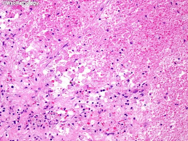 This histopathology image depicts post-chemotherapy therapy-induced changes in a Wilms tumor (nephroblastoma) of the kidney, illustrating how treatment alters tumor architecture in surgical resection specimens. The slide, stained with Hematoxylin and Eosin (H&E), shows extensive coagulative necrosis within tumor tissue, evidenced by homogeneous eosinophilic zones with preservation of basic architectural outlines but loss of viable tumor cells. Interspersed fibrous stroma forms bands and nodules replacing neoplastic blastemal and epithelial elements, consistent with treatment response. Within the fibrotic matrix, numerous hemosiderin-laden macrophages appear as dark intracellular pigment, reflecting prior hemorrhagic components and iron storage. Vascular remodeling and residual inflammatory cells may be present at the periphery of necrotic/fibrotic areas. Overall, the neoplasm is partially or largely regressed with sparse residual viable tumor in some cases, aligning with risk stratification into low, intermediate, or high categories based on residual tumor burden and histologic response. Clinically, this post-therapy histology informs NWTS and SIOP treatment decisions, guiding adjuvant chemotherapy intensity and radiotherapy planning. The image underscores standardized terminology—coagulative necrosis, fibrosis, hemosiderin-laden macrophages, regression—and demonstrates how histologic response correlates with prognosis and postoperative management. This morphologic assessment complements clinical staging and informs multidisciplinary planning for chemotherapy regimens, nephron-sparing considerations, and long-term surveillance and follow-up.