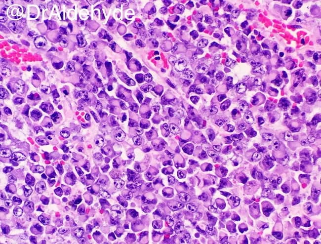 Histopathology slide of a rhabdoid tumor showing the classic INI1/SMARCB1-deficient rhabdoid phenotype on hematoxylin-eosin stained tissue. Bright-field microscopy reveals loosely cohesive sheets of monomorphic tumor cells with eccentrically placed vesicular nuclei, prominent nucleoli, and intracytoplasmic eosinophilic inclusions. Cells may adopt a plasmacytoid or rhabdomyosarcomatous appearance. The pattern is highly characteristic but not entirely specific, and SMARCB1/INI1 loss by immunohistochemistry supports the diagnosis. Rhabdoid tumors are aggressive neoplasms most common in infancy and childhood, typically arising in the kidney or central nervous system (atypical teratoid/rhabdoid tumor), but extrarenal and extra-CNS sites have been described. Clinically relevant associations include rapid progression and poor prognosis, requiring prompt multimodal therapy. In differential diagnosis, focal rhabdoid features can complicate other renal neoplasms such as Wilms tumor, mesoblastic nephroma, and renal cell carcinoma, making accurate IHC and molecular testing essential. Diagnostic significance centers on recognizing INI1-deficient rhabdoid morphology, which guides prognosis and informs genetic counseling. This image serves educational purposes for pathologists, clinicians, and trainees, enabling histologic-pathologic correlation, differential diagnosis, and study of SMARCB1-related tumorigenesis across pediatric and, occasionally, adult populations. Correlate with radiology and clinical data for comprehensive diagnosis and treatment planning; consider SMARCB1 sequencing in ambiguous cases. This enhances diagnostic accuracy and patient management.