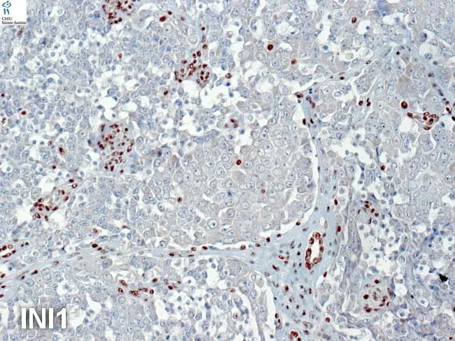 Immunohistochemistry image of a renal rhabdoid tumor (RTK) demonstrating loss of nuclear INI1 (SMARCB1) staining in tumor cells with preserved INI1 in endothelial and inflammatory cells, providing an internal positive control. Morphologically, the lesion shows sheets of rhabdoid cells with large polygonal shapes, eccentrically placed nuclei, prominent nucleoli, and abundant cytoplasm; paranuclear inclusions may be present. The tumor exhibits an overlapping immunophenotype: vimentin positivity with pan-c cytokeratin and EMA expression, compatible with the dual mesenchymal-epithelial nature of RTKs. In contrast, the tumor cells are negative for smooth muscle actin (SMA), desmin, and S‑100 protein. Myogenin and neuroendocrine markers can be variably expressed in some cases, underscoring potential immunophenotypic overlap with other renal neoplasms. INI1 loss is a defining feature of SMARCB1-deficient tumors, though rare RTKs retain INI1 and SMARCA4 (BRG-1) inactivation can occur with BRG-1 loss. Clinically, INI1 deficiency strongly supports a diagnosis of RTK and carries prognostic implications due to aggressive behavior. The image also notes that renal medullary carcinoma can display INI1 loss, highlighting overlapping but distinct SWI/SNF-deficient entities. This IHC pattern aids in differential diagnosis from Wilms tumor and other renal neoplasms, informs molecular testing strategy, and guides research into targeted therapies targeting the SWI/SNF complex.