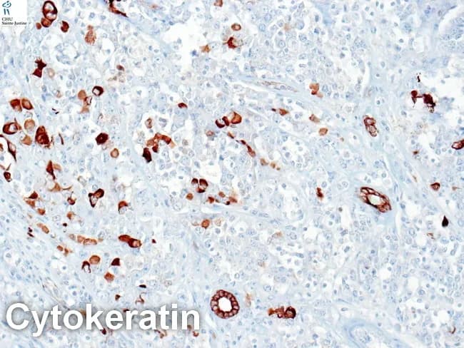 This bright-field immunohistochemistry image demonstrates cytokeratin immunostaining (DAB brown) in a renal neoplasm consistent with rhabdoid tumor of the kidney (RTK). The tissue is paraffin-embedded kidney parenchyma with hematoxylin counterstain. Rhabdoid cells are large, polygonal, and exhibit abundant eosinophilic cytoplasm with eccentrically placed nuclei and prominent nucleoli; paranuclear cytoplasmic inclusions are a characteristic feature. Cytokeratin positivity is strong and focal, particularly around rhabdoid inclusions, underscoring epithelial differentiation within a predominantly mesenchymal-appearing tumor. EMA is often positive in RTK, while SMA, desmin, and S-100 are typically negative, supporting non-skeletal muscle lineage. Myogenin and neuroendocrine markers may be variably expressed in some cases. Clinically, RTK is an aggressive pediatric renal tumor with poor prognosis; an immunoprofile showing CK+/EMA+/vimentin positivity and negative myogenic markers aids differentiation from Wilms tumor and other renal neoplasms. This image is valuable for diagnostic pathology education, panel discussions, and research on RTK histogenesis and immunophenotype. The CK anchor marker illustrated here assists in precise histopathologic classification and informs differential diagnosis, prognostic assessment, and potential therapeutic planning.