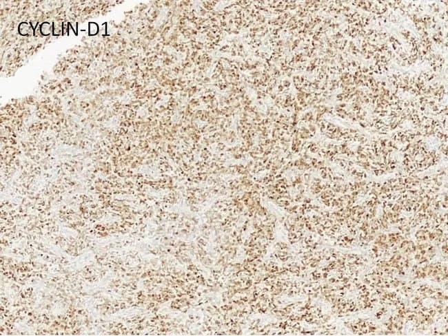 Immunohistochemistry on a formalin-fixed paraffin-embedded renal tumor section illustrating the clear cell sarcoma of the kidney (CCSK) immunophenotype. The bright-field image uses DAB chromogen with hematoxylin counterstain to visualize tumor cells. The staining pattern is non-specific for CCSK: tumor cells show immunoreactivity for cyclin D1, Bcl-2, SATB2, TLE1, vimentin, CD10 and CD56 with patchy to diffuse positivity. In contrast, epithelial markers including cytokeratin, CAM5.2, and EMA are negative, and neural markers such as S100 protein and GFAP fail to highlight tumor cells. Neuroendocrine markers (synaptophysin, NSE) and vascular markers (CD34, Factor VIII) are not expressed; muscle markers (desmin), polyclonal CEA, and membranous CD99 are also negative. P53 is typically not overexpressed in conventional CCSK but is markedly increased in the anaplastic variant. Ki-67 labeling index is approximately 20% (range 8–32%), reflecting moderate proliferative activity. While this IHC profile supports CCSK, it is not entirely specific and must be interpreted with conventional histology and clinical context. The panel’s combination—WT1 and PAX8 negativity with CCSK morphology—helps distinguish from Wilms tumor. This image illustrates the importance of immunophenotyping in pediatric renal tumors for accurate diagnosis, prognosis, and treatment planning, including chemotherapeutic regimens tailored to CCSK and consideration of anaplastic transformation.