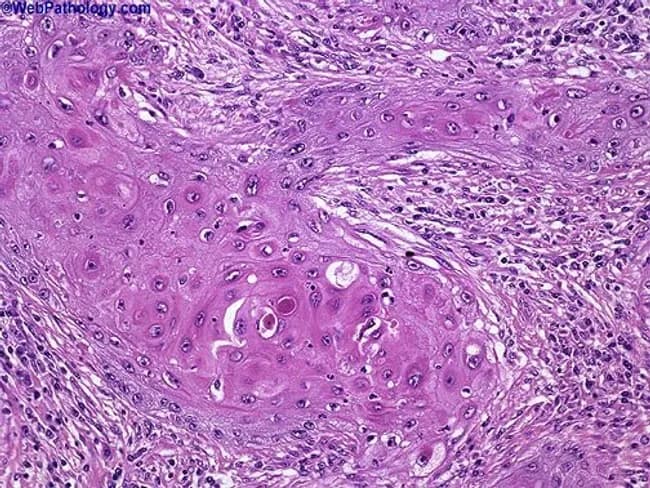 This histopathology image depicts a cutaneous squamous cell carcinoma on routine hematoxylin and eosin stained section. The biopsy shows nests of malignant squamous cells with keratinization and abundant keratin pearls, indicating squamous differentiation. The tumor exhibits moderate differentiation, evidenced by intercellular bridges, eosinophilic cytoplasm, nuclear pleomorphism, hyperchromasia, and mitotic activity. Invasion into the surrounding dermal stroma is evident, with desmoplastic-type fibrous response in some areas. The epidermis overlying the lesion shows dysplastic changes, and keratin pearl formation within tumor nests is a hallmark of keratinizing SCC. The architecture includes irregular cords and nests of polygonal cells, occasional central keratinization, and keratinized pearls of varying sizes. Clinically, these features suggest a malignant cutaneous neoplasm with potential for local invasion; staging would consider depth of invasion and perineural or lymphovascular involvement. This image is relevant for diagnostic pathology, histology education, and tumor biology research, illustrating characteristic squamous differentiation, keratin production, and invasion patterns. Differential considerations include well-differentiated keratinizing SCC versus moderately-to-poorly differentiated forms, verrucous carcinoma, and basal cell carcinoma with squamous features. The visual cues—keratin pearls, keratinization, and cohesive epidermal-derived tumor islands—assist in confirming diagnosis and guiding surgical management. Correlation with clinical data will inform prognosis and adjuvant therapy decisions and multidisciplinary care planning.