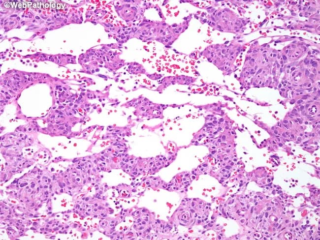 Juxtaglomerular cell tumor (reninoma) on bright-field light microscopy using Hematoxylin and Eosin staining. Modality: Histopathology; magnification high (40x objective). Localization: kidney, renal cortex, juxtaglomerular apparatus region; derived from juxtaglomerular cells; renin-producing. Morphology: highly vascular neoplasm composed of cords or nests of monomorphic tumor cells separated by prominent sinusoidal vascular spaces and interposed capillaries. The tumor demonstrates a pronounced angiovascular network with branching vessels that may resemble a stag-horn pattern typical of hemangiopericytoma; variably arranged small veins and muscular arterioles are present. The cells show uniform, round to ovoid nuclei with scant cytoplasm and minimal pleomorphism; mitotic activity is low. The vascular spaces contribute to a pseudovascular, labyrinthine architecture. Clinically, JGCTs are renin-secreting tumors causing secondary hypertension; radiology often reveals a small, well-circumscribed renal mass. Immunohistochemistry (if performed) may support juxtaglomerular lineage (e.g., renin positivity). Diagnostic significance: recognition of this histology supports diagnosis of juxtaglomerular cell tumor and informs surgical management; differential includes hemangiopericytoma-like renal tumors and other renal neoplasms with prominent vascularity. Potential clinical use cases: diagnostic education, pathology reference, case characterization, research on renin-angiotensin system tumors, and surgical planning. This image exemplifies the classic vascular architecture and cellular uniformity used to teach renal tumor histology and differential diagnosis skills.