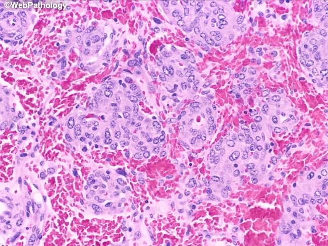 Imaging modality and technique: Light microscopy of hematoxylin and eosin stained renal tumor tissue (H&E). Specimen shows renal cortical parenchyma with neoplastic cells arranged in aggregates. Primary subject: Juxtaglomerular cell tumor (reninoma), a rare renin-secreting renal neoplasm. Anatomical localization: Kidney, renal cortex, juxtaglomerular apparatus region, perivascular renal cortex. Morphology: Epithelioid tumor cells are round to polygonal with moderate eosinophilic granular cytoplasm. Nuclei are uniform and vesicular with evenly dispersed chromatin and small nucleoli. Cells form nests and cords with occasional concentric rings around arterioles, reflecting juxtaglomerular origin. The stroma shows a delicate vascular network with interspersed red blood cells; mitotic activity is low; overall cellularity is variable. Notable features: concentric perivascular patterns around arterioles; cohesive arrangement; clear cytoplasmic granularity. Diagnostic significance: Histologic features are characteristic of juxtaglomerular cell tumor; correlation with clinical data (hypertension, elevated renin) supports diagnosis. Differential considerations: other renal neoplasms such as renal cell carcinoma (clear cell, papillary), oncocytoma, angiomyolipoma; however, perivascular concentric arrangement around arterioles favors juxtaglomerular lineage. Clinical correlation: typically presents in young adults with secondary hypertension; renin release may be elevated; treatment often includes nephron-sparing resection. These features aid pathologists in distinguishing juxtaglomerular tumors from mimics and guide surgical management in selected cases.