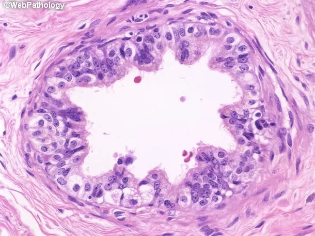 Imaging modality: Light microscopy of a hematoxylin and eosin–stained paraffin-embedded tissue section of efferent ductules from the caput epididymidis. The specimen shows multiple small tubular ducts arising from rete testis and converging toward the proximal epididymis with a centrally placed, undulating lumen. The epithelial lining is pseudostratified columnar, comprising tall ciliated cells interspersed with shorter nonciliated (absorptive) cells and scattered basal cells. A subtle lamina propria contains sparse lymphocytes. The mucosa forms a pronounced border around the lumen, reflecting active resorption of tubular fluid, a primary function of these ducts. The ciliated cells appear to augment luminal transport, while absorptive cells exhibit apical microvilli features. The surrounding smooth muscle and connective tissue provide peristaltic support. Notable features include variable epithelial height and occasional lymphocytes in the mucosa. In normal specimens, the lumen is irregular (undulating) and the epithelium shows mixed cell types without dramatic cytologic atypia. Clinically, this histology is relevant for evaluating obstructive infertility, congenital agenesis, or inflammatory involvement of the male reproductive tract. This image is useful for education, teaching histology of male reproductive ducts, differential diagnosis against epididymal pathologies, and research on sperm transport physiology. High magnification review emphasizes microvascular integrity and epithelial plasticity.