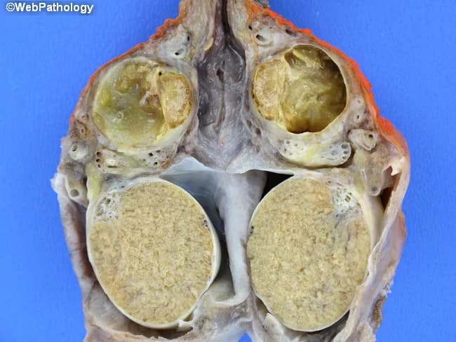 Comprehensive Description: This is a gross pathology photograph of a male scrotal specimen showing xanthogranulomatous epididymo-orchitis with abscess formation. The inflammatory process is predominantly centered in the epididymis with secondary involvement of adjacent testicular tissue. The abscess walls are thickened and lined by numerous foamy histiocytes, lipid-laden macrophages, and chronic inflammatory cells. On cut sections, the epididymal ducts and surrounding stroma display pale, granulomatous nodules intermixed with necrotic debris and sparse lymphocytes. The overall appearance is a granulomatous, macrophage-rich inflammatory reaction consistent with xanthogranulomatous inflammation, which can mimic neoplasm clinically. In this case, bilateral scrotal contents are involved, though the most conspicuous changes reside in the epididymal tissue; testicular parenchyma is relatively preserved. The image illustrates the histologically distinctive foamy macrophage infiltrate within the abscess walls and surrounding granulomatous response. Clinically, this entity represents a chronic infectious or inflammatory process that may require surgical drainage or excision and antibiotic therapy. Differential considerations include tuberculous epididymo-orchitis, malakoplakia, other granulomatous infections, and rarely epididymal/neoplastic processes. This image is educational for medical students, pathologists, urologists, and radiologists to recognize xanthogranulomatous epididymo-orchitis and its abscess morphology. The accompanying histology demonstrates macrophage-rich inflammatory tissue with lipid-laden cytoplasm and occasional multinucleated giant cells for educational reference.