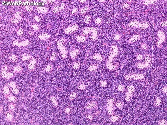 Histopathology image of a prepubertal testis with acute lymphoblastic leukemia involvement. Hematoxylin and eosin (H&E) stained tissue shows diffuse interstitial infiltration by small to medium lymphoblasts arranged in loose sheets between seminiferous tubules. Neoplastic cells display scant cytoplasm, high nuclear-to-cytoplasmic ratio, round to oval nuclei with fine chromatin and inconspicuous nucleoli. The infiltrate disrupts normal testicular architecture by expanding the interstitium and compressing adjacent tubules while largely preserving some tubules in variable fashion. Mitotic activity may be present and cellular density is high, with a basophilic cytoplasm that stains purple-pink. The pattern resembles lymphomatous involvement, reflecting a leukemic infiltration rather than focal germ cell tumor. Immunophenotypic features (if tested) would typically include TdT positivity and B-cell markers (CD10, CD19) with CD34 positivity common in blasts; however, these are inferred from diagnostic context rather than visible in the H&E image. Clinically this finding reinforces that the testis can act as a sanctuary site in leukemia and may be bilateral in pediatric cases, potentially predating overt marrow relapse or presenting at remission. Correlation with peripheral blood counts and bone marrow studies is essential to determine systemic involvement and guide therapy, including consideration of testicular-directed therapy or CNS prophylaxis.