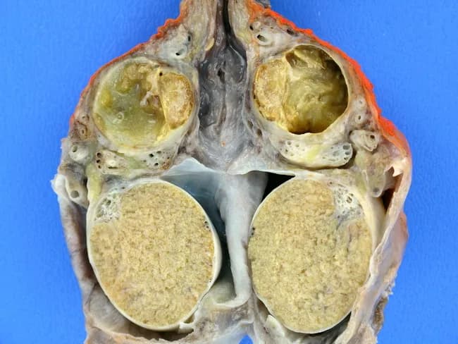 Gross pathology photograph of the scrotal contents after dissection shows pronounced inflammatory changes centered in the epididymis with secondary abscess formation. The epididymal walls are thickened and friable, separating a pale yellow to tan pus-filled cavity from surrounding tissue. The abscess cavities appear irregular and are lined by inflammatory granulation tissue. The adjacent testicular parenchyma is largely unremarkable or only minimally involved. In this case, numerous foamy histiocytes populate the walls of the abscess, consistent with xanthogranulomatous epididymo-orchitis. The foamy macrophages are lipid-laden and may be accompanied by multinucleated giant cells, lymphocytes, and plasma cells; cholesterol clefts and necrotic debris may be present in the inflammatory loci. The overall pattern is chronic inflammation with focal granulomatous response. Clinically, this entity can simulate an infiltrating neoplasm and may present with scrotal swelling, pain, or mass. Pathologic significance lies in recognizing xanthogranulomatous inflammation as a distinct chronic infectious/inflammatory process rather than malignancy; microbiologic correlation is helpful; treatment typically involves antibiotic therapy and surgical drainage or epididymectomy, depending on extent. Differential diagnoses include tuberculous epididymo-orchitis, malakoplakia, chronic bacterial epididymitis, and less commonly granulomatous vasculitis. This specimen provides educational utility for gross-pathology and diagnostic pathology teaching, illustrating how histiocyte-rich, foamy macrophage inflammation can shape scrotal disease.