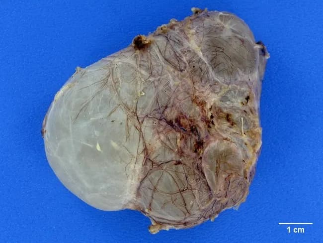 This gross pathology photograph depicts a scrotal adnexal cystic structure consistent with a spermatocele arising from dilatation of efferent ductules near the rete testis or the head of the epididymis. The specimen shows a thin-walled, translucent (glass-like) cyst attached to posterior testicular/epididymal tissue, with variable lobulation indicating possible multilocular configuration. A single or multiple cysts may be present, filled with clear, straw-colored fluid. The fluid composition may include motile or non-motile spermatozoa, a hallmark distinguishing spermatocele from hydrocele, which contains serous fluid without sperm. The surrounding testicular parenchyma appears unremarkable; vascular and stromal tissues may show marginal adhesions. The scale bar indicates 1 cm for size estimation; overall dimensions correspond to a small to moderate cystic lesion, typically a few millimeters to a few centimeters in diameter. Pathophysiology involves dilation of efferent ductules or proximal epididymal ducts with preserved testicular architecture, absence of malignant features, and minimal inflammatory infiltrate. Clinically, spermatocele presents as a painless scrotal swelling, often anterior or superior to the testis, distinct from hydrocele by fluid content. This image supports education in gross anatomy of the male reproductive tract, differential diagnosis of scrotal cystic lesions, and correlates with radiologic and clinical findings used to guide conservative versus surgical management, including epididymal-sparing excision when indicated.
