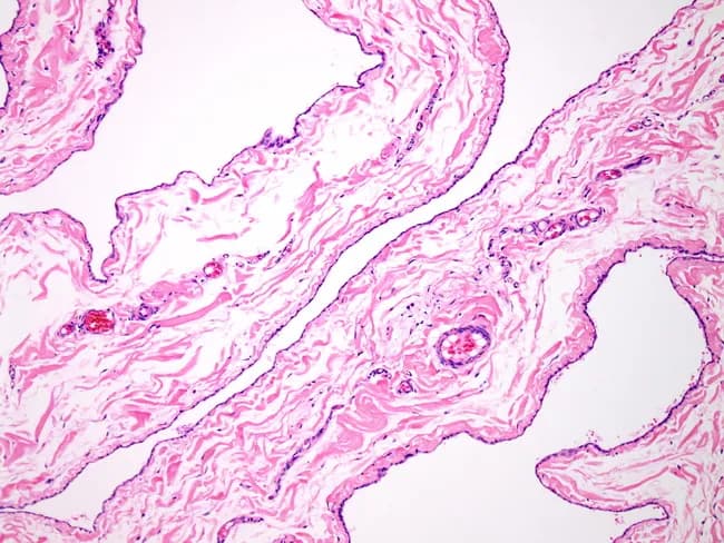 This light-microscopy histology image displays the wall of a spermatocele arising from the epididymal duct. The cyst wall is thin and delicate, composed of loose fibroconnective tissue that forms a simple capsule around a fluid-filled lumen. The epithelial lining is cuboidal to flattened and often ciliated, consistent with epididymal origin. The luminal contents are not the focus here, but the lining and wall architecture are characteristic of a benign epididymal cyst. Surrounding stroma is mild and non-destructive, with minimal inflammatory change and no epithelial atypia or invasion. Collectively these features support a diagnosis of epididymal cyst/spermatocele rather than a neoplasm. Clinically, spermatocele management favors simple excision, with recurrences uncommon; rare cases may be complicated by testicular torsion. The image is prepared as a paraffin-embedded tissue section, stained with Hematoxylin and Eosin, and viewed at low to mid magnification, enabling assessment of cyst wall thickness, epithelial morphology, and stromal context. In diagnostic practice, this histology aids differentiation from hydrocele (epididymal cyst without sperm content), tunica albuginea changes, or malignant epididymal neoplasms. Relevant clinical correlations include infertility considerations, testicular pain, and scrotal swelling. This representation reinforces the benign, excretory-epididymal nature of the lesion and supports surgical planning.