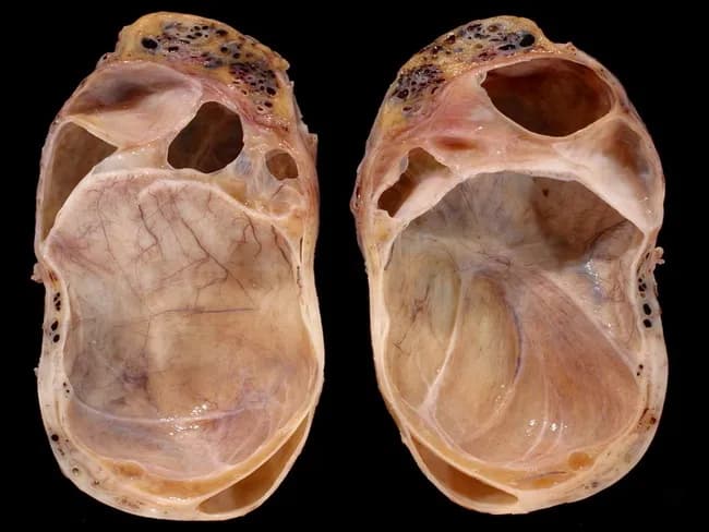 Gross pathology photograph of a scrotal/testicular specimen with a large hydrocele and an adjacent spermatocele. The bilateral testes are opened and presented in frontal orientation, allowing assessment of the hydrocele sac and contained parenchyma. A prominent hydrocele capsule surrounds the testis, producing marked compression and resultant pressure atrophy of the underlying testicular parenchyma. The residual functional testicular tissue is visible as a thin crescent-shaped rim occupying the inferior pole of each testis. At the superior pole, a small saccular structure corresponds to a spermatocele within the tunica vaginalis. The tunica albuginea is intact, with no discrete intratesticular mass identified on gross inspection. The cut surfaces show pale, trabeculated parenchyma with attenuated vascularity; the surrounding fluid appears clear or faintly opalescent. Overall morphology favors a chronic hydrocele with secondary testicular atrophy rather than neoplasia. The image highlights the anatomic relationship between hydrocele, residual testicular tissue, and epididymal cyst formation. Clinically relevant implications include potential impairment of spermatogenesis and testicular function, consideration for hydrocelectomy or surveillance, and the need for histopathologic confirmation to exclude occult malignancy. This photograph is a valuable teaching aid for pathology, urology, and medical education focusing on hydrocele-associated testicular atrophy and spermatocele. Educationally relevant for clinical correlation teaching.
