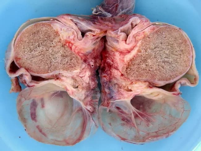 Macroscopic photograph of a scrotal hydrocele specimen measuring 5.0 cm in greatest dimension. The image shows an excised or opened scrotal sac consisting of two large, thin-walled hydrocele envelopes encasing the testicular tissue, with clear straw-colored serous fluid visible in the lumen. The walls appear translucent and delicate, lined by a single layer of mesothelial cells (cuboidal to flattened). The hydrocele forms when fluid accumulates between the visceral and parietal layers of the tunica vaginalis, often secondary to inflammation, trauma, hernia, or neoplastic processes, and congenital hydrocele results from persistent communication with the peritoneal cavity via a patent processus vaginalis. The surrounding tunica albuginea and testicular parenchyma appear normal, though edema and mild vascular congestion may be noted due to surgical manipulation. This specimen demonstrates the classic pathophysiology: serous fluid accumulation with a simple mesothelial lining and no solid tumor or pus, distinguishing it from inflammatory or infectious orchitis or malignant testicular lesions. Clinically, hydroceles may present as progressive scrotal swelling; etiologies include irritation of the mesothelial lining by hernia, epididymo-orchitis, trauma, or paratesticular tumors. Management ranges from watchful waiting in small, asymptomatic cysts to hydrocelectomy or aspiration in larger or symptomatic cases. This educational image aids recognition of hydrocele morphology and supports differential diagnosis in scrotal swellings.