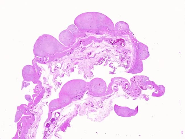 Low-power brightfield histology section stained with hematoxylin and eosin reveals multiple well-circumscribed, smooth-surfaced nodules composed of dense eosinophilic hyalinized fibroconnective tissue embedded within the tunica of a vascular wall. The nodules are sparsely cellular, containing few fibroblasts within a homogeneous, acellular-appearing extracellular matrix rich in collagen. Surrounding tunica shows fibrous thickening with accentuated eosinophilia and limited intervening stroma. No necrosis, calcification, hemorrhage, or acute inflammatory infiltrate is evident. The overall pattern is characteristic of hyalinization and fibrous remodeling of a vascular tunic, more consistent with chronic degenerative change or organized scar tissue than with neoplastic processes. The nodules’ smooth, rounded margins and lack of cellular atypia argue against malignant vascular tumors. Diagnostic significance rests on recognizing hyalinized nodules within tunica as a remodeling or scar-related phenomenon; correlation with clinical vascular risk factors and gross anatomy is advised. Differential considerations include hyaline arteriolosclerosis, fibrous intimal hyperplasia, fibrous nodules in tunica, and organized scar tissue of prior injury. Clinically, this finding could reflect long-standing hypertension or diabetes with vascular remodeling. Educational and reference material usage includes histology teaching, QA pathology slides, and comparative studies of vascular wall pathology. This image serves as a concise reference for teaching vascular histomorphology.