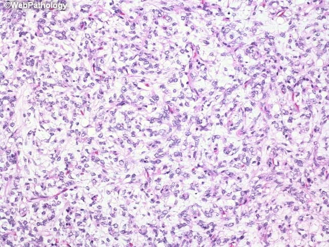 This histopathology image depicts a relatively cellular area within a myxoid liposarcoma on Hematoxylin and Eosin staining using bright-field light microscopy. The tumor is embedded in a prominent myxoid (mucinous) extracellular matrix, rendered in pale bluish-purple, with a delicate, arborizing capillary vascular network that is characteristic of this entity. Scattered lipoblasts are present, identified by cytoplasmic lipid vacuoles that indent (scallop) the nuclei, and by occasional hyperchromatic, rounded to oval nuclei. The neoplastic cells range from small to moderately sized spindle- to stellate-shaped cells with variably eosinophilic, scant cytoplasm and mild nuclear atypia. Cellular areas show increased density compared with the abundant myxoid background. Mitotic figures are uncommon in this field, and there is no conspicuous necrosis. The overall pattern—myxoid stroma with a plexiform capillary network and lipogenic cells—supports a diagnosis of myxoid liposarcoma; higher cellularity regions can be encountered in the cellular variant. This histology distinguishes from other lipomatous neoplasms and from other myxoid sarcomas by the presence of lipoblasts and the characteristic branching vasculature. Clinically, dx is often reinforced by molecular tests for DDIT3 gene rearrangement. Correlate with imaging (MRI/CT) and clinical presentation for staging and treatment planning.