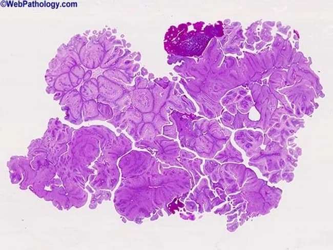Imaging modality and technique: Light microscopy of fixed tissue stained with Hematoxylin and Eosin (H&E). Specimen: genital mucosa biopsy from a cauliflowers-like neoplastic lesion on the penile skin, viewed at low magnification. Location: genital mucosa of penis, corona glandis region, a typical site for condyloma acuminatum. Morphology: hallmark papillary or polypoid fronds with warty, cauliflower-like architecture; marked papillomatosis and acanthosis producing thickened, undulating epithelium with elongated rete ridges; hyperkeratosis and parakeratosis at the surface. Cellular features: koilocytosis in the upper epithelial layers, characterized by nuclear enlargement with perinuclear halos and irregular nuclear membranes, consistent with HPV infection. The dermal stroma shows mild chronic inflammatory infiltrate and fibrovascular cores within the papillary projections; cytologic atypia is absent, indicating benign HPV-related lesion. Diagnostic impression: condyloma acuminatum (genital wart) most commonly caused by low-risk HPV types 6 and 11; presence of koilocytic change and papillomatous growth supports HPV-induced lesion. Clinical significance: differentiates from malignant or precancerous processes; important for STI counseling and management; differential diagnoses include verruca vulgaris, penile intraepithelial neoplasia, and Buschke-Lowenstein tumor in rare cases. Potential uses: educational reference, correlating histology with gross morphology, and guiding patient counseling and treatment planning. Correlation with clinical presentation strengthens diagnostic confidence and informs management.