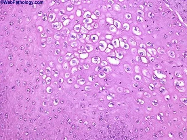 Photomicrograph of a genital mucosal biopsy stained with Hematoxylin and Eosin, viewed under brightfield light microscopy at low to moderate magnification (approx. 200x–400x). The section shows stratified squamous epithelium with condylomatous acanthosis and koilocytotic change. Koilocytes reveal enlarged, irregular nuclei with perinuclear halos and cytoplasmic clearing; binucleated cells are occasionally present. In addition, resinoid (raisinoid) nuclear changes with nuclear enlargement and hyperchromasia are evident in some keratinocytes, consistent with HPV-induced cytopathic effect. The epithelium displays mild to moderate dysplasia in foci, compatible with condyloma acuminatum harboring HPV-related dysplastic change. The underlying stroma is edematous without overt invasion. HPV types 16, 18, 31, and 33 are commonly associated with high-grade dysplasia in anogenital condylomas; detection by typing supports risk stratification for progression to high-grade intraepithelial neoplasia and carcinoma in susceptible mucosal sites. Note: This is a descriptive representation for imaging metadata; real-world interpretation requires clinical correlation and laboratory confirmation with HPV typing. The image exemplifies classic cytopathic effects of HPV infection in condylomatous epithelium. This description supports search queries for HPV-related anogenital lesions, koilocytosis, raisinoid nuclei, dysplasia, condyloma acuminatum, and high-risk HPV types (16/18/31/33); useful for educational, diagnostic, and research contexts. Clinically correlate with HPV typing and patient risk factors. Carefully.