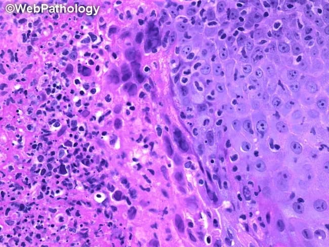 Light microscopy of a hematoxylin and eosin stained mucocutaneous biopsy demonstrates histopathologic features of herpes simplex virus infection. The specimen comprises stratified squamous epithelium from a genital or oral lesion with mucosal involvement. At high magnification, epithelial cells show ballooning degeneration, multinucleation, and prominent nuclear molding. Intranuclear eosinophilic inclusions (Cowdry type A) occupy the karyoplasm with marginated chromatin and variable nuclear clearing. These changes are frequently accompanied by vesiculation, keratinocyte crowding, and focal necrosis at the lesion edge. An inflammatory infiltrate dominated by lymphocytes and neutrophils resides in a dense subepithelial zone. The combination of multinucleated keratinocytes, eosinophilic intranuclear inclusions, and nuclear enlargement is highly suggestive of active HSV infection and helps differentiate from varicella-zoster virus or cytomegalovirus, which may show different inclusion bodies or owl’s eye nuclei, respectively. Clinically, HSV-2 is commonly genital; HSV-1 is typically orolabial, but overlap occurs. Histology supports clinical differential and, when combined with PCR or immunohistochemistry, confirms HSV typing. This image is clinically relevant for dermatology, infectious disease, pathology education, and research on mucocutaneous viral pathology and antiviral therapy evaluation. The image serves as a teaching reference for recognizing classic HSV cytopathic effects on routine histology and correlates with molecular typing and lesion localization.