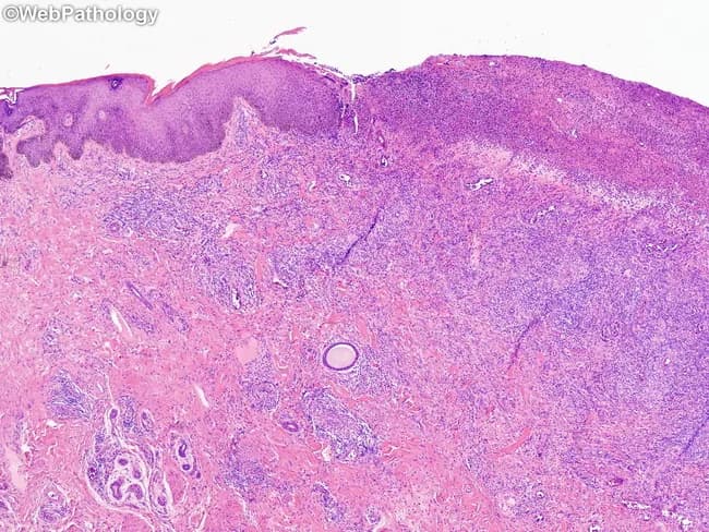Penile foreskin and glans mucosal biopsy obtained during evaluation of confluent genital ulcers in an immunocompromised patient with chronic lymphocytic leukemia. Hematoxylin and eosin stained tissue shows epidermal ulceration with underlying dermal inflammatory infiltrate and necrosis. The epidermis often displays ballooning degeneration of keratinocytes and occasional multinucleated giant cells, reflecting herpes simplex virus cytopathic effect. Intranuclear eosinophilic Cowdry type A inclusions may be present within atypical keratinocytes, though at this low magnification they can be difficult to appreciate. Dermal perivascular inflammation, edema, and abundant neutrophils are common in the ulcer bases, with focal lymphoplasmacytic infiltrates. The lesion is confluent and shallow, with subepithelial pseudomembrane and necrotic debris. In immunocompromised hosts the histology may be more extensive with epidermal necrosis and persistent ulceration. These morphological features, together with compatible clinical history of recurrent painful genital ulcers, support a diagnosis of genital herpes simplex infection caused by herpes simplex virus type 1 or type 2. Differential diagnosis includes syphilitic chancres, chancroid, candidal balanitis, and non-infectious etiologies; culture, PCR for HSV DNA, or direct fluorescent antibody testing can confirm the diagnosis. Appropriate antiviral therapy is indicated and infection control measures advised to prevent transmission.