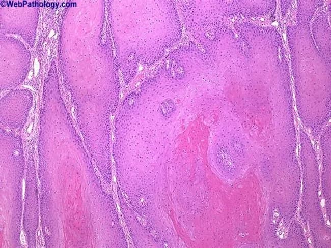 Imaging modality: Light microscopy of hematoxylin and eosin stained penile tissue biopsy. The histology shows a verruciform, exophytic growth pattern arising from penile skin and involving the glans region. The surface demonstrates marked hyperkeratosis with pronounced acanthosis. Beneath this, large, well-differentiated nests of keratinizing squamous epithelium extend into the dermis with broad, pushing margins rather than infiltrative invasion. Cellular atypia is minimal, with orderly maturation and abundant keratin production; mitotic figures are scarce. The nests are composed of mature squamous cells exhibiting extensive keratinization, sometimes forming keratin-filled cores or keratin pearls; the overlying epithelium remains thickened and papillomatous. Inflammation may be present at the periphery. Overall, this pattern is characteristic of verrucous carcinoma of the penis (penile carcinoma, verruciform variant), a slow-growing, locally aggressive squamous cell carcinoma with low metastatic potential. Clinically, it presents as a large exophytic mass in middle-aged men and requires wide local excision with clear margins; differentiation from condyloma acuminatum is essential because of treatment implications. The image underscores the diagnostic importance of architectural pushing borders, minimal cytologic atypia, and pronounced keratinization in establishing a verrucous carcinoma diagnosis and guiding surgical management. No lymphovascular invasion identified; margins critical. Immunohistochemistry may aid in ruling out analogous lesions.