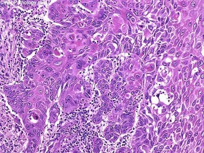 High-power histology image of penile squamous cell carcinoma with dermal invasion. Malignant squamous cells form irregular nests and cords that extend from the overlying epithelium into the dermis, producing finger-like projections and disruption of normal dermal architecture. Cells exhibit squamous differentiation with hyperchromatic pleomorphic nuclei, increased nuclear-to-cytoplasmic ratio, conspicuous nucleoli, and keratinizing features. Rare dyskeratotic cells are present within tumor nests, reflecting abnormal keratinization. Focal parakeratosis and occasional keratin pearls may be observed in places, along with a peritumoral inflammatory infiltrate in the adjacent dermis. Depth of invasion should be measured from the basement membrane of the overlying squamous epithelium to the deepest invasive cancer cells; this parameter has established prognostic significance in penile SCC. Vascular invasion, when present, further increases risk of metastasis and warrants more aggressive management. The cited Mod Pathol 2001 study emphasizes depth of invasion and lymphovascular invasion as predictors of cancer progression, underscoring the clinical relevance of accurate histologic assessment for staging and treatment planning. Clinically, these histopathologic features inform surgical margins, nodal assessment, and adjuvant therapy considerations. Overall, the image depicts an infiltrative penile SCC with dyskeratosis, an aggressive tumor subset requiring careful correlation with clinical and radiologic data. For accurate prognosis and management.