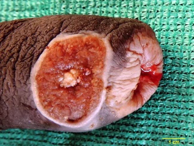 Gross photograph of a total penectomy specimen from a 63-year-old man with a 6-month history of a painless non-healing penile ulcer. The external penis shows chronic balanitis with phimosis. On longitudinal section, a diffusely infiltrative tumor occupies the foreskin and glans penis. The lesion measures approximately 3 cm in maximum diameter, with a variegated tan-brown to gray-white cut surface and focal necrosis. The tumor penetrates the mucocutaneous junction into submucosa; there is limited visible invasion into adjacent penile tissues, though deeper sampling may reveal extension. The specimen was obtained after a clinical diagnosis of penile squamous cell carcinoma, with histopathology confirming invasion beyond the epithelial layer. The case emphasizes the natural history of penile cancer associated with chronic phimosis and uncircumcised status, presenting as a painless ulcer. The findings have significant diagnostic and prognostic implications; tumor size, local extent to foreskin and glans, and potential lymphatic drainage correlate with risk of nodal metastasis and need for radical surgical management. This image supports educational review of penile SCC gross morphology, differential considerations in penile ulcers, and gross-pathology correlation to histologic invasion patterns.