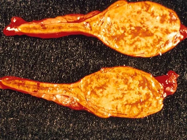 Gross pathology photograph of an adrenal gland cortical lesion from a 35-year-old male with Cushing syndrome, showing a yellow, lipid-rich cortical surface consistent with zona fasciculata. The resections reveal an encapsulated, well-circumscribed adrenal cortical adenoma projecting from the adrenal cortex. The tumor surface is smooth to slightly lobulated with uniform golden-yellow hue, reflecting abundant intracellular lipid in clear/polyhedral cells. On gross examination, the lesion appears discrete and distinct from surrounding yellow-brown medulla and normal cortex. The cut surface (if available) would likely be homogeneous, pale to bright yellow, without necrosis or hemorrhage, aligning with benign adenomatous growth. These features correlate with cortisol hypersecretion and the clinical phenotype of Cushing’s syndrome. Histologically, adenomas originate from adrenal cortex and show benign architecture; cytoplasmic lipid leads to the characteristic color. The image supports a diagnosis of cortisol-producing adrenal cortical adenoma, a common cause of endogenous Cushing’s, typically cured by distal excision. Differential considerations include adrenocortical carcinoma (larger, irregular, invasive) and bilateral micronodular hyperplasia though this specimen demonstrates a solitary, well-defined lesion. Clinically, the correlation with endocrine evaluation—elevated serum cortisol, suppressed ACTH in primary adrenal disease—guides management and prognosis. Overall, this specimen provides crucial gross-pathology correlation for endocrinologic syndromes and surgical pathology education contexts.