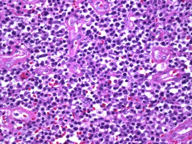 Histopathology image from a cutaneous syphilitic chancre after Hematoxylin and Eosin staining demonstrates a dense inflammatory infiltrate in the dermis with a perivascular pattern. The cellular milieu is dominated by plasma cells, accompanied by lymphocytes and histiocytes. Endothelial swelling and small-vessel endarteritis are evident, forming the classic histologic triad associated with Treponema pallidum infection. The epidermis may be relatively preserved with only mild spongiosis; necrosis is minimal. Although non-specific in isolation, the combination of perivascular plasma cell–rich infiltrate and endarteritis strongly points toward primary syphilis in the appropriate clinical context. Special stains or immunohistochemistry can reveal spirochetes, though they may be absent in this field. Clinically relevant for differentiating chronic inflammatory dermatoses and serving as an educational exemplar of syphilitic histopathology. Diagnostic significance lies in supporting early syphilis when integrated with serology (RPR/VDRL, FTA-ABS/TP-PA) and clinical findings; informs treatment decisions and epidemiologic interventions; useful for medical education, dermatopathology reviews, and infectious disease reference repositories.