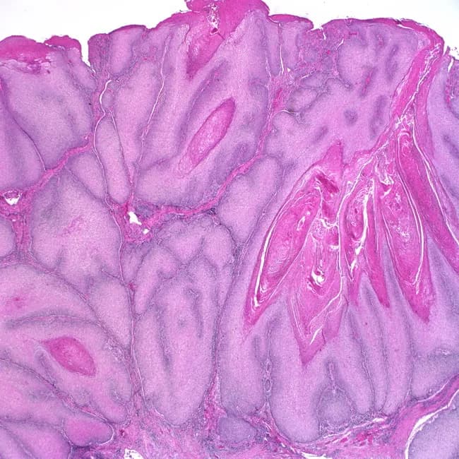 Histology: Light microscopy of an Hematoxylin and Eosin (H&E) stained biopsy from oral mucosa. The tissue shows stratified squamous epithelium over fibrous stroma with an exophytic, verruciform surface. The neoplasm is well differentiated and displays bulbous, finger-like downgrowths with broad, pushing borders into the underlying connective tissue. Tumor cells exhibit minimal cytologic atypia, abundant keratinization, intercellular bridges, and occasional keratin pearls. Invasion is present but shallow and non-destructive, consistent with a verrucous carcinoma phenotype. The architecture emphasizes exophytic growth with prominent surface maturation and blunt-to-rounded rete pegs that markedly extend into stroma while preserving cell polarity. The lesion tends to be locally aggressive yet with low metastatic potential. These features differentiate it from conventional keratinizing squamous cell carcinoma, which shows more infiltrative margins and higher mitotic activity. Clinically, verrucous carcinoma manifests as a large, cauliflower-like exophytic mass on mucosal surfaces (oral cavity, oropharynx), often causing local destruction without distant spread. Management typically involves wide local excision with clear margins; radiotherapy is generally avoided due to risk of anaplastic transformation. This image illustrates classic histopathologic hallmarks and provides diagnostic and educational value for surgical pathology, oncology, and oral medicine. Correlates with clinicopathologic staging and informs prognosis and treatment planning in multidisciplinary tumor boards and educational contexts.
