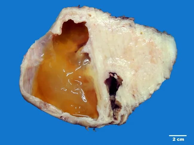 Imaging modality: gross pathology photograph of a hysterectomy specimen, sagittal cross-section through the uterus, highlighting a large cervical fibroid with degenerative changes. The cervix is enlarged by a well-circumscribed, firm mass measuring approximately 14 cm in maximum dimension. On the cut surface, cystic degeneration is evident, with multiple large, rounded cystic spaces filled by seromucinous fluid, imparting a yellow-orange gelatinous appearance. Intervening solid areas show dense, whorled fascicles of smooth muscle arranged in a classic 'whorled' or 'raw silk' pattern. The capsule is a fibrous envelope; the tumor coexists with adjacent myometrium and cervix, with no gross invasion into surrounding structures described. The external surface is pale white with occasional surface friability. The presence of cystic degeneration reflects long-standing growth and secondary ischemic changes commonly seen in large fibroids. These features help distinguish benign leiomyoma from malignant muscle tumors when evaluated grossly, though confirmation requires histology demonstrating benign smooth muscle cells with minimal mitotic activity. Clinically, a large cervical leiomyoma can cause mass effect and pelvic pain; surgical treatment—hysterectomy or myomectomy—may be indicated based on symptoms and patient fertility considerations. This specimen emphasizes classic gross hallmarks: mature smooth muscle whorling, degenerative changes, and seromucinous content within cystic spaces consistent with uterine fibroid pathology.