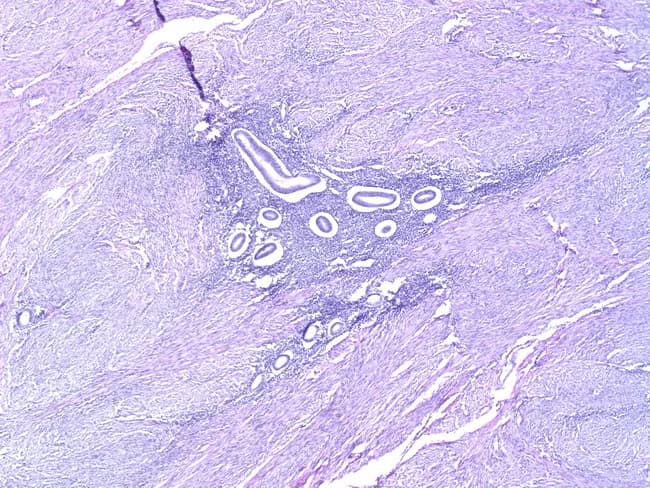 Comprehensive Description: This is a high-magnification light microscopy image of uterine tissue illustrating adenomyosis. The specimen is a myometrial section in which ectopic endometrial glands and stroma are embedded within the myometrium, below the endomyometrial junction. The pathognomonic feature is endometrial glands at least approximately 2.5 mm (100x field) deep from the junction, accompanied by relative myometrial hypertrophy and fibromuscular stroma. In the field, glands may be inactive or hormonally responsive, with basally located nuclei and stromal decidual-type changes possible depending on cyclic hormones. Occasionally, glands are scant or absent, which can complicate recognition and raise the differential with low-grade endometrial stromal sarcoma; careful assessment of architecture and invasion depth is required. The surrounding myometrium often shows hyperplasia or smooth muscle proliferation with separation of gland clusters by fibrous or edematous stroma. This histologic appearance corresponds to clinical symptoms such as dysmenorrhea, menorrhagia, and pelvic pain, and aids differentiation from fibroids or normal endometrium. The image demonstrates key features including ectopic glands within myometrium, myometrial thinning and thickening, and gland-to-stroma ratios. Clinically, adenomyosis is associated with uterine enlargement and pain; radiologic MRI findings may show thickened junctional zone, but histology confirms diagnosis. Image is educational for pathology, gynecology, and research.