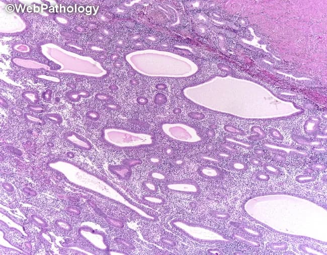 This hematoxylin and eosin stained section presents endometrial tissue from a perimenopausal patient with abnormal uterine bleeding. The architectural pattern shows cystically dilated glands with marked crowding and a back-to-back arrangement within fibromuscular stroma, yielding an overall increased gland-to-stroma ratio. Gland lumina are variably tortuous and irregular in contour, but the epithelial lining demonstrates only minimal cytologic atypia in this field. There is no evident stromal invasion or myometrial extension. The morphology is compatible with endometrial hyperplasia; features may reflect non-atypical hyperplasia or, if nuclear atypia is present in broader sections, atypical hyperplasia/EIN. In the clinical context provided, abnormal non-cyclical bleeding—postmenopausal bleeding, menorrhagia, dysmenorrhea, or intermenstrual bleeding—raises concern for progression to endometrial neoplasia. Differential considerations include complex hyperplasia with atypia, endometrioid intraepithelial neoplasia, and early endometrial carcinoma, particularly if atypia is evident on sampling. Pathologic significance lies in stratifying risk of progression and guiding management, which ranges from surveillance and hormonal therapy to surgical intervention depending on age, fertility wishes, and the presence of cytologic atypia. This image thus supports a radiologic-pathologic correlation for endometrial proliferative disorders in women presenting with abnormal uterine bleeding. Correlation with imaging and clinical data strengthens diagnostic confidence. These findings guide patient-centered treatment planning. decisions.