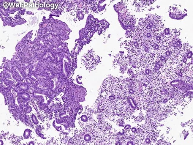 Imaging modality: Light microscopy of a hematoxylin and eosin stained endometrial tissue section, showing features used to diagnose atypical endometrial hyperplasia/endometrioid intraepithelial neoplasia (AEH/EIN). The specimen is endometrium within the uterine cavity; glandular epithelium with stromal backdrop. The histology demonstrates dense glands with back-to-back arrangement, yielding a gland:stroma ratio greater than 1, consistent with AEH/EIN criteria. Glands are cytologically and architecturally atypical relative to adjacent non-atypical glands, with nuclear enlargement, hyperchromasia, and irregular contours. The focus typically exceeds 1 mm in a single linear dimension and commonly comprises more than five to ten glands; multiple foci should not be pooled to satisfy the size criterion. Squamous morular areas are not part of the AEH/EIN assessment and are excluded from this ratio. Artifacts such as gland telescoping or artifactual displacement may create transient density increases but lack true cytologic atypia and architectural disorder. Benign mimics and invasion must be excluded; no myometrial invasion is visible at this plane. This image serves as a reference for diagnosing premalignant endometrial lesions, guiding differential diagnosis (benign hyperplasia without atypia, endometrial carcinoma, adenocarcinoma in situ), and informing clinical management decisions, including surveillance, risk stratification, and potential treatment strategies in gynecologic oncology.