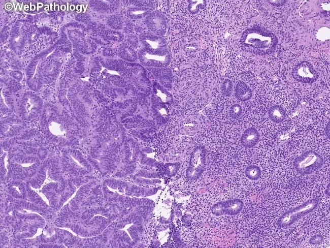 Histology, bright-field microscopy of an H&E stained endometrial tissue section. The specimen represents endometrium with atypical hyperplasia/endometrioid intraepithelial neoplasia (AEH/EIN). In this field, glands exhibit a gland-to-stroma ratio greater than 1, with crowding and architectural complexity consistent with preinvasive endometrial neoplasia. The left half demonstrates crowded, irregular glands that are cytologically and architecturally distinct from the adjacent normal background endometrium on the right. The proliferating glands show mild-to-moderate cytologic atypia, including increased nuclear size, hyperchromasia, and occasional nuclear stratification, while maintaining overall glandular architecture without overt invasion. Glands that are cystically dilated, atrophic glands, or glands with squamous morular metaplasia are absent, helping to differentiate AEH/EIN from benign mimics. The lesion focus exceeds 1 mm in greatest dimension, satisfying the size criterion for AEH/EIN. Benign mimics such as polyps, metaplasias, disordered proliferative endometrium, fragmentation, telescoping artifact, repair, and noninvasive patterns are excluded in favor of a precursor lesion. This histologic pattern denotes a premalignant endometrial condition with significant risk of progression to endometrioid adenocarcinoma if untreated. Clinical risk factors include prolonged estrogen exposure, obesity, and nulliparity; management typically involves careful surveillance or surgical intervention depending on clinical context. This finding aids risk stratification and informs targeted management decisions for patients.