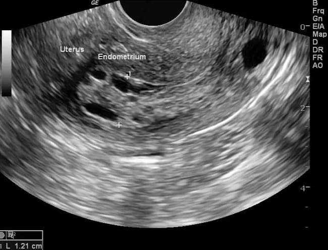 Imaging modality: Transvaginal ultrasound (TVUS) using two-dimensional grayscale ultrasound (B-mode) technique in sagittal (longitudinal) view of the uterus. Precise anatomical localization: uterus with a thickened endometrial stripe measuring approximately 12 mm, consistent with endometrial thickening in a postmenopausal patient. Visual features include a bright, echogenic endometrial lining interrupted by hypoechoic or anechoic cystic spaces within the endometrium, indicating architectural alteration and polypoid or cystic change. In the clinical history provided, endometrial biopsy demonstrated nonatypical endometrial hyperplasia (EH), underscoring nonmalignant proliferative activity but with potential risk for progression if atypia develops. The imaging finding of thickened endometrium (>5 mm in symptomatic postmenopausal women) is non-specific and requires histopathologic confirmation for diagnosis of EH or other pathology such as simple hyperplasia, atypical hyperplasia, or carcinoma. The diagnostic significance lies in risk stratification for uterine neoplasia and guides management decisions including biopsy, surveillance, or therapeutic intervention. Differential considerations include endometrial carcinoma, endometrial polyps, glandular hyperplasia without atypia, chronic endometritis, and atrophic uterus with incidental cystic changes. Clinical correlation emphasizes postmenopausal bleeding history, obesity or polycystic ovarian syndrome risk factors, and the need for biopsy to establish definitive diagnosis. This case (rID 30100) illustrates how TVUS endometrial thickness measurement informs the sequence of workup and confirms pathology via sampling.