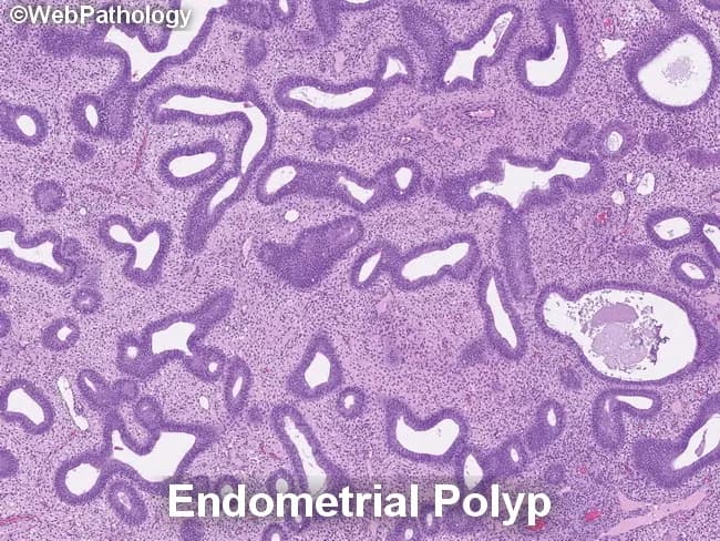 Histology – Light microscopy of paraffin-embedded endometrial tissue, stained with Hematoxylin and Eosin. The specimen demonstrates a polypoid lesion arising from the endometrium within the uterine cavity. Glandular architecture shows a spectrum from crowded, tightly packed endometrial glands to adjacent, less crowded glands embedded in a fibrous stromal background. The crowded glands are variably irregular in size and contour, with some shaping that mimics adenomatous crowding. The stromal component is relatively compact or fibrotic, containing thick-walled, dilated blood vessels. Glands generally orient parallel to the surface epithelium, a pattern characteristic of polyps, with occasional cystically dilated glands. There is no overt cytologic atypia or mitotic abnormality evident in the epithelial cells at this magnification. The background stroma lacks neoplastic infiltration and shows minimal inflammatory change. The combination of polypoid architecture, gland crowding confined to a focal lesion, and preserved noncrowded glands distinguishes endometrial polyps from diffuse endometrial hyperplasia. If crowded glands displayed nuclear enlargement, pseudostratification, or loss of polarity, the differential would broaden to atypical endometrial hyperplasia or carcinoma in situ; thus, this histology argues against EH with atypicality. Clinically, findings correlate with abnormal uterine bleeding; management includes hysteroscopic polypectomy with follow-up for recurrence or progression risk, and patient education.