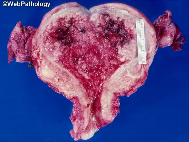 Gross pathology photograph of a hysterectomy specimen showing a hemorrhagic, necrotic endometrial tumor replacing the entire endometrium. The uterus appears enlarged with a bulky, friable mass occupying the endometrial cavity and extending to the myometrium; surfaces show irregular papillary fronds and necrotic red-black areas. A measuring scale is present for gross dimension. The lesion is grossly extensive, with heterogeneous color and soft, oozing tissue; cervical portion may be involved; invasion into surrounding tissues suggested in the cut surfaces but not proven histologically in this view. Diagnosis confirmed on histology as papillary serous carcinoma of the endometrium, a high-grade serous carcinoma characterized by complex papillary architecture, marked nuclear atypia, frequent mitoses, and often psammoma bodies; typically TP53 mutated. Clinically significant as an aggressive endometrial cancer with propensity for early lymphovascular invasion and extrauterine spread; prognosis is poorer than endometrioid adenocarcinoma. Relevance to clinical practice includes accurate histopathologic classification impacting treatment planning (surgery, adjuvant chemotherapy, possible radiotherapy) and staging (FIGO). This image is useful for educational demonstrations of gross endometrial carcinomas, differential diagnosis with other high-grade endometrial neoplasms, and radiology-pathology correlation. Potential applications include medical education, pathology review, and tumor biology research. Biopsy specimens and staging data refine prognosis and therapeutic decision-making in multidisciplinary care.