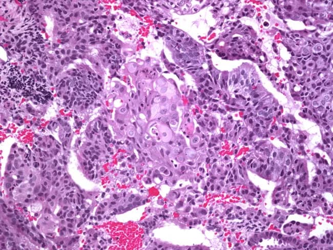 Imaging modality: Bright-field histology on a hematoxylin and eosin-stained formalin-fixed paraffin-embedded endometrial tissue section, viewed under light microscopy at high magnification (approximately 400x). The specimen shows endometrioid adenocarcinoma characterized by malignant, back-to-back glandular structures formed by columnar to cuboidal epithelium with oval, hyperchromatic nuclei and conspicuous nucleoli, and frequent mitotic figures. Intermixed within the glandular component are poorly formed squamous morules composed of small nests of squamoid cells with squamous differentiation, lacking substantial keratinization. The morules are surrounded by the glandular tumor and embedded in desmoplastic stroma with inflammatory infiltrate and occasional red blood cells in adjacent vasculature. The overall architecture demonstrates focal invasion into stromal tissue, consistent with carcinoma. The combination of gland-forming endometrioid morphology with focal squamous morules constitutes squamous differentiation within endometrial carcinoma. Clinically relevant implications include tumor heterogeneity, potential grading nuances, and differential considerations including adenosquamous carcinoma; immunohistochemical profiling may aid confirmation (e.g., p16, ER/PR status) though not shown. This histology supports a endometrial malignancy with mixed differentiation; appropriate surgical staging and adjuvant therapy decisions should consider invasion depth and lymphovascular invasion. This description aligns with endometrioid carcinoma with squamous morphology and morular differentiation. Further molecular profiling may refine prognosis and therapy planning for personalized care.
