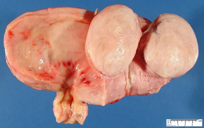 Gross pathology photograph of a uterine specimen displaying a submucosal leiomyoma, a fibroid. The image shows an external uterus surface with a prominent, rounded, pale pink‑tan mass arising beneath the endometrium and projecting toward the uterine cavity. The specimen rests on a blue background with a centimeter scale for size reference, enabling approximate measurement of the lesion. The lesion appears well circumscribed, firm, and homogeneous, with no obvious necrosis or hemorrhage on this gross view. The surface texture is smooth with mild lobulation typical of fibroid tissue composed of intersecting smooth muscle fascicles. This submucosal location explains distortion of the endometrial lining and potential abnormal uterine bleeding in affected individuals. The gross morphology supports a diagnosis of leiomyoma over other uterine neoplasms, though histopathology would confirm features such as organized smooth muscle bundles, a whorled pattern, and absence of malignant characteristics. Clinically, submucosal fibroids are important because they may cause infertility, menorrhagia, or recurrent pregnancy loss, and surgical management decisions depend on size, location, and patient factors. This image is educational for gross pathology training, surgical planning discussions, and radiologic–pathologic correlation. This representation aids medical students, residents, and clinicians in correlating gross features with imaging and histology.
