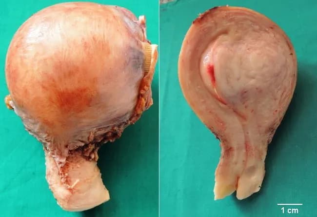 This gross pathology image shows a hysterectomy specimen from a 42-year-old female with a large intramural leiomyoma arising within the myometrium, the most frequent fibroid location. The tumor is centered in the uterine wall with a well-circumscribed, rounded appearance and an organized gray-pink to pink-tan cut surface. The surface exhibits a classic whorled pattern consistent with smooth muscle cell bundles and fibrous stroma, while the surrounding myometrium appears otherwise unremarkable macroscopically. External contour of the uterus is mildly enlarged by the intramural mass, with no obvious hemorrhage or necrosis identified on this gross examination. Ultrasound had detected a mass within the uterine wall correlating with the pathologic finding. Clinically, the patient presented with menorrhagia and back pain—typical symptoms of uterine fibroids. Histologically, intramural leiomyomas are benign neoplasms composed of uniform spindle-shaped smooth muscle cells arranged in interlacing fascicles; however a microscopic diagnosis is not shown here. The significance lies in distinguishing benign leiomyoma from malignant sarcoma, and in guiding treatment choices such as hysterectomy or myomectomy based on reproductive goals. This image provides educational demonstration of gross morphology, localization within the myometrium, and the characteristic cut-surface texture of intramural fibroids.