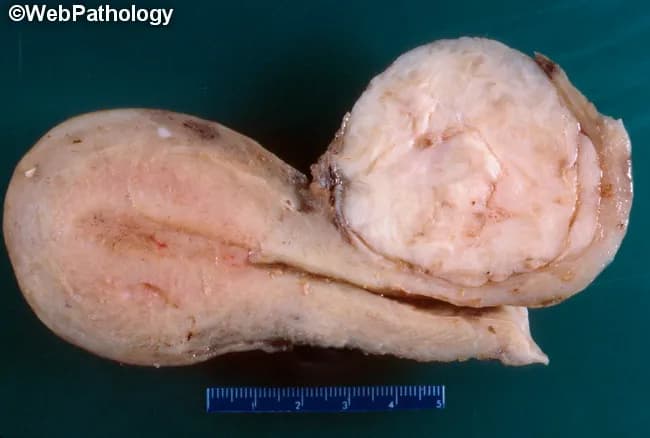 This is a gross pathology photograph of a uterine specimen demonstrating a leiomyoma (fibroid) arising within the uterine corpus, with the cervix oriented to indicate the uncommon cervical location. The image shows a pale, ivory-white to tan, firm nodular mass with a smooth, whorled cut surface embedded in myometrium and extending toward the left uterine body. The lesion appears well circumscribed, encapsulated by native myometrium, and measures on the order of several centimeters in greatest dimension as suggested by the included metric scale. The gross morphology is characteristic of benign smooth muscle neoplasia: firm consistency, whorled fascicles, and uniform pale coloration, with minimal surface necrosis or hemorrhage. The cervical portion remains recognizable; the corpus is to the left, consistent with the note that the corpus is the primary site in this specimen. The image lacks invasion into surrounding structures on gross inspection. This specimen supports a diagnosis of uterine leiomyoma (fibroid), a common benign tumor in women. Cervical involvement or atypical presentation must be considered. Clinically, fibroids cause menorrhagia, pelvic pressure, and reproductive dysfunction; management ranges from observation to myomectomy or hysterectomy depending on symptoms and fertility considerations. Correlation with histology confirms benign smooth muscle tumor.
