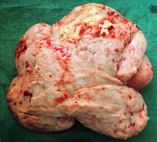 Gross macroscopic image of a giant subserosal uterine leiomyoma resected from a 42-year-old female. Modality: Gross pathology photography; specimen oriented with cut surface exposed for architectural assessment. The mass is large, firm, pale white to tan, with a lobulated contour and a lightly nodular surface. On cut, the lesion shows a homogeneous, whorled pattern of intersecting smooth muscle bundles with intervening fibrous stroma; margins are well defined, consistent with a benign neoplasm. No obvious hemorrhage or necrosis is evident on the exposed surface. Subserosal location implies growth toward the serosal surface with outward protrusion from the uterine wall. The uterus shows a single, predominant fibroid; the appearance is typical for leiomyoma, though giant size may cause bulk symptoms. Histology (to be confirmed) would demonstrate spindle-shaped myocytes in sweeping fascicles, with minimal atypia and low mitotic activity; hyaline degeneration may be present in larger lesions. Clinically, fibroids are estrogen-responsive and common in women of reproductive age; differential diagnoses include cellular leiomyoma and leiomyosarcoma, with clinical correlation and imaging guiding management. This specimen supports a benign diagnosis and is valuable for education, pathology atlases, and gynecologic oncology teaching.