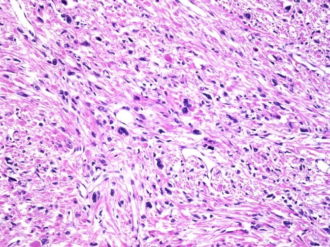 Imaging modality: Light microscopy of a hematoxylin and eosin stained uterine tissue section. Anatomical context: female reproductive system; uterus (myometrium); tissue type smooth muscle; region myometrial wall. Visual features: densely packed spindle to polygonal cells arranged in interlacing fascicles; marked cellular pleomorphism with bizarre, hyperchromatic nuclei; multinucleated smooth muscle cells; abundant eosinophilic cytoplasm; low to absent mitotic activity; no coagulative necrosis; scattered fibrous stroma and thick wavy collagen bands; occasional hyalinization. Interpretation: Symplastic (bizarre) leiomyoma, a histologic variant of benign uterine leiomyoma; despite alarming cellular atypia, lack of mitotic activity and necrosis supports benign behavior. Clinical significance: differentiate from leiomyosarcoma; crucial to avoid overtreatment; in premenopausal patients, often associated with progestin exposure; diagnosis guides conservative surgical management if fertility preservation is desired. Related terms: pleomorphic, symplastic, bizarre leiomyoma; also called unusual cell-variants of fibroid. Potential clinical use cases: educational histology demonstration; diagnostic training; differential diagnosis teaching; pathology review conferences; research on hormonal associations in leiomyoma variants. This image is helpful for learners to recognize that marked cellular atypia alone does not imply malignancy in smooth muscle tumors, provided mitotic activity and necrosis are absent.