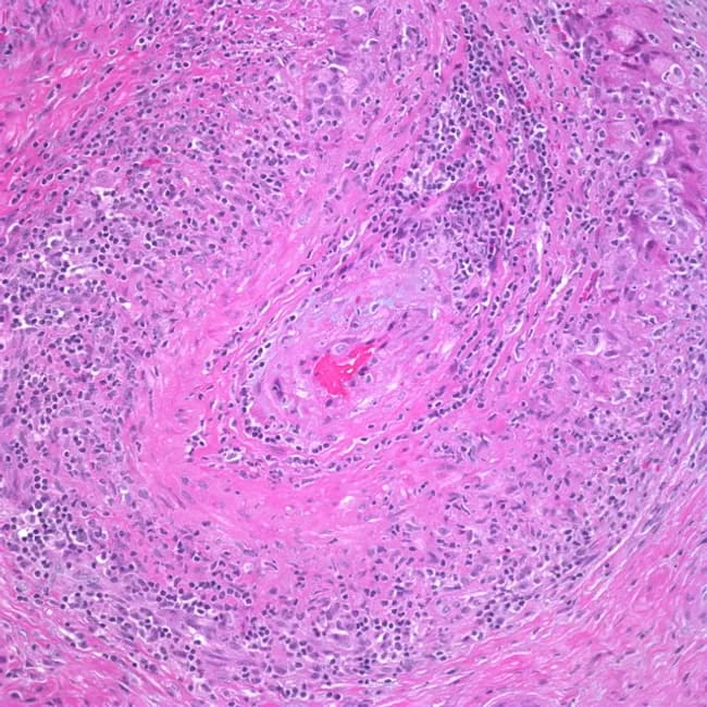 High-power hematoxylin and eosin stained transverse section of a medium-sized artery demonstrating granulomatous arteritis. The lumen is narrowed by edema and fibrosis of the intima, while the tunica media is uniformly expanded by a mixed inflammatory infiltrate. Lymphocytes, plasma cells, and histiocytes predominate, with several multinucleated giant cells visible in the upper right quadrant. The internal elastic lamina is variably destroyed, with fragmentation evident at the media- adventitia interface. Transmural inflammation produces concentric thickening of the vessel wall and marked luminal compromise. Admixed eosinophils are sparse; occasional foamy histiocytes emphasize granulomatous architecture. The adventitia shows mild edema and vascular remodeling. Overall features are classic for granulomatous vasculitis, most consistent with giant cell arteritis (temporal arteritis) or other large-vessel vasculitides such as Takayasu arteritis. Diagnostic significance: histology provides definitive confirmation when clinical suspicion is high and ESR/CRP elevations are present. Differential considerations include polyarteritis nodosa, infectious vasculitis, and eosinophilic granulomatosis with polyangiitis depending on clinical context. Clinically relevant correlations include age >50 years, new headaches, jaw claudication, visual symptoms, and constitutional signs. This image is valuable for pathology education, residency training, and radiologic-pathologic correlation studies in vasculitis. Useful for teaching differential diagnosis and correlating clinical features with histologic patterns in practice.