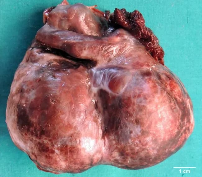 Gross pathology photograph of a salpingo-oophorectomy specimen from an adult female with acute pelvic pain. The excised adnexa measures approximately 10 x 8 x 6 cm and comprises an ovary adherent to the fallopian tube. The external surface is bosselated and variably dark bluish black in color. The parenchyma contains multiple cysts filled with altered blood and clots, separated by conspicuous fibrous septae, consistent with hemorrhagic degeneration. On gross inspection, ischemic necrosis predominates in most areas, with focal viable zones displaying serous cystadenoma-like features. The specimen is multiloculated with a thick capsule and torsion-related vascular compromise. Ovarian torsion, or adnexal torsion, involves rotation of the ovary and part of the tube around its vascular pedicle and is a surgical emergency requiring prompt intervention to prevent necrosis. Hemorrhagic infarction reflects obstruction of arterial inflow with venous outflow stasis. The narrative notes torsion's bimodal age distribution, affecting reproductive-age and postmenopausal women, with risk factors including benign and malignant neoplasms and corpus luteum cysts. Clinically, these findings align with severe abdominal pain, acute pelvic condition, and ultrasound-detected complex adnexal mass. This specimen illustrates torsion with hemorrhagic cysts and a benign serous neoplasm component, valuable for teaching, differential diagnosis, and surgical pathology education.