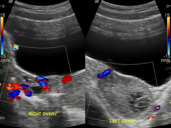 Pelvic ultrasound with color and power Doppler was performed to evaluate acute left lower quadrant pain in a young female. Gray-scale (B-mode) imaging demonstrates a normal right ovary with preserved parenchymal echotexture and a small left ovarian hemorrhagic cyst, with several tiny peripheral follicles. A pivotal radiologic finding is a twisted vascular pedicle just cranial to the left ovary, compatible with ovarian torsion. Color Doppler evaluation shows absence of detectable arterial and venous flow within the left ovary, while the right ovary maintains normal perfusion. The left ovary is tender to transducer pressure, and pedicle twist explains the acute presentation with vomiting. The absence of Doppler flow is highly specific for torsion, although a normal flow pattern does not completely exclude it. The exam emphasizes searching for an underlying ovarian mass or hemorrhagic cyst as a possible precipitating lesion. The radiologic diagnosis supports urgent surgical exploration to preserve ovarian viability. Clinical correlation includes abrupt onset abdominal pain in a reproductive-age patient, nausea, vomiting, and localized adnexal tenderness. Differential considerations include early torsion with intermittent flow, hemorrhagic corpus luteum cyst, adnexal mass, or adnexitis. This case underscores the diagnostic value of color Doppler in acute pelvic pain and the need for prompt gynecologic consultation.